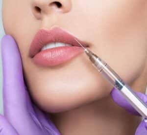 Image of a woman getting filler injected into her upper lip